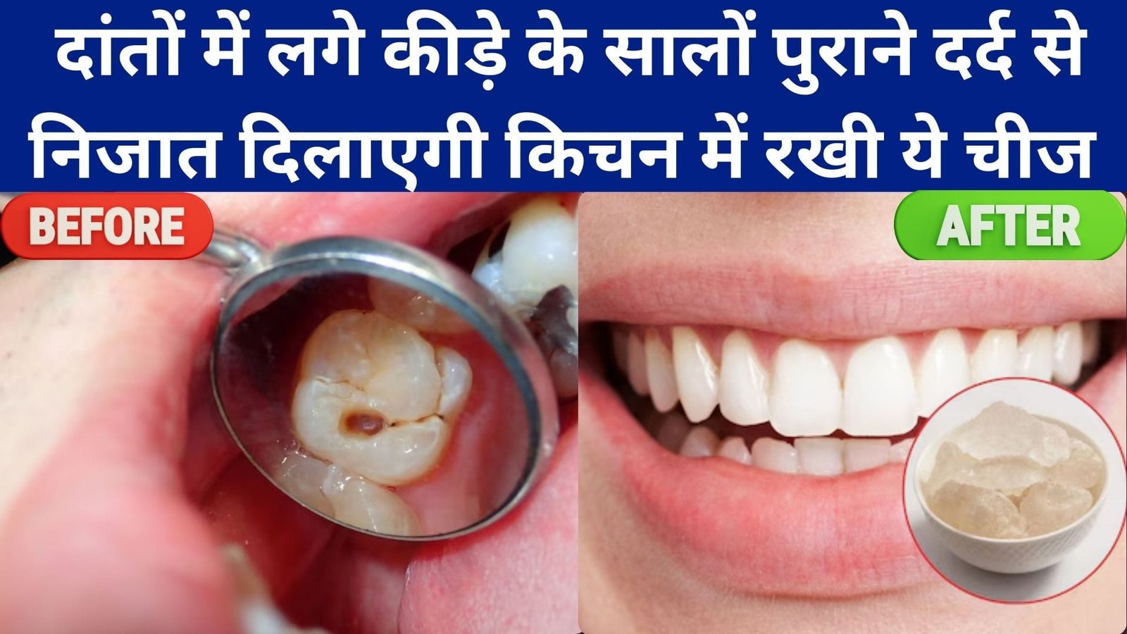 Cavity Home Remedies: दांतों में लगे कीड़े के सालों पुराने दर्द से निजात दिलाएगी किचन में रखी ये चीज, सफेद मजबूत होंगे दांत